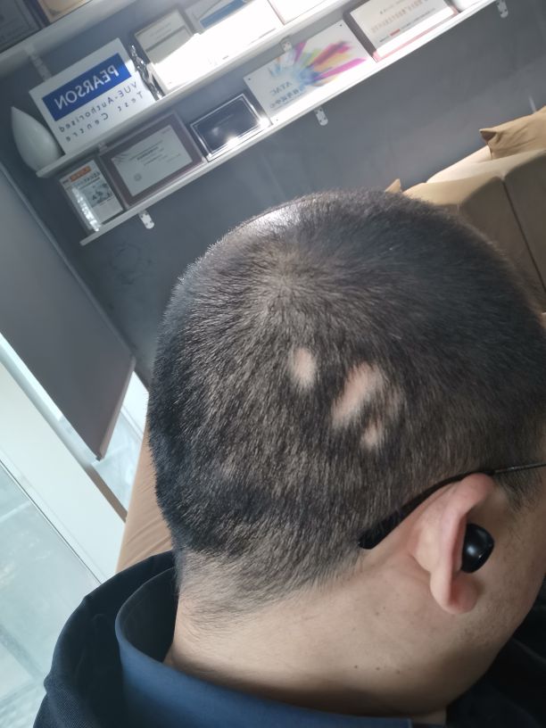 发现斑秃刚好又开始掉头发怎么办,突然发现斑秃怎么治疗