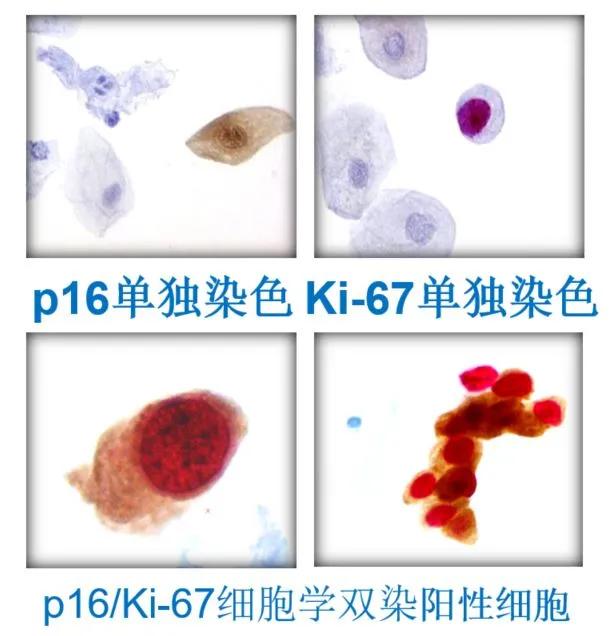 「一路有理」优化诊断，让高级别病变不再“隐形”