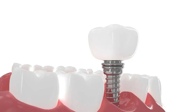 两次种牙仍失败,三甲医院专家详解为何这类人群不适合种植牙