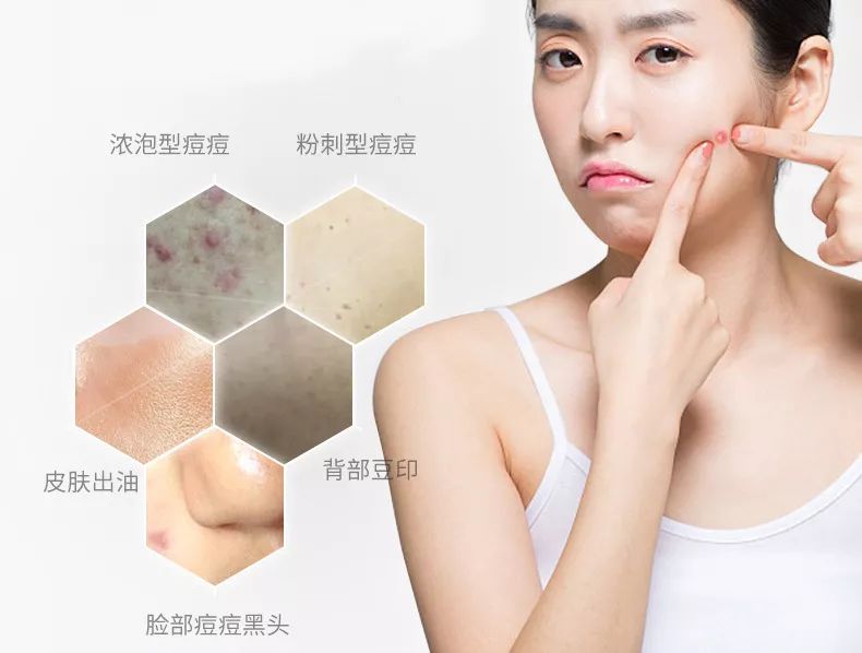 用香皂洗脸去油祛痘,硫磺香皂洗脸可以祛痘去油吗