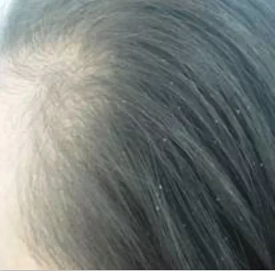12岁女孩“头皮屑”多到吓人!竟是家人一个习惯造成的!