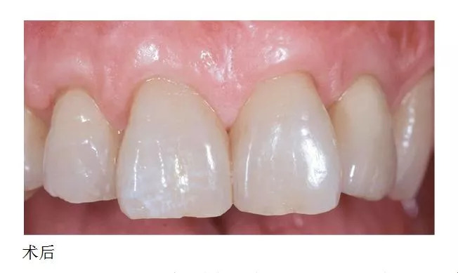 牙龈退缩怎么样刷牙,牙龈退缩牙根暴露怕冷热怎么办