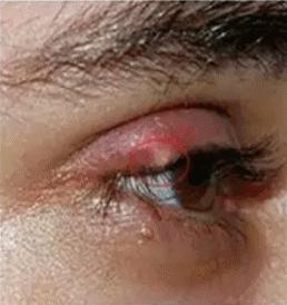 四岁孩子反复起针眼,5岁小朋友长针眼