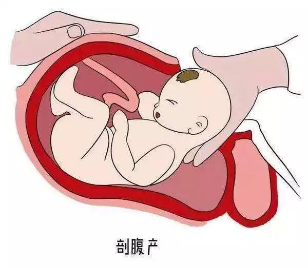 涨姿势|顺产or剖宫产?哪种分娩好?是时候给你扫扫盲了