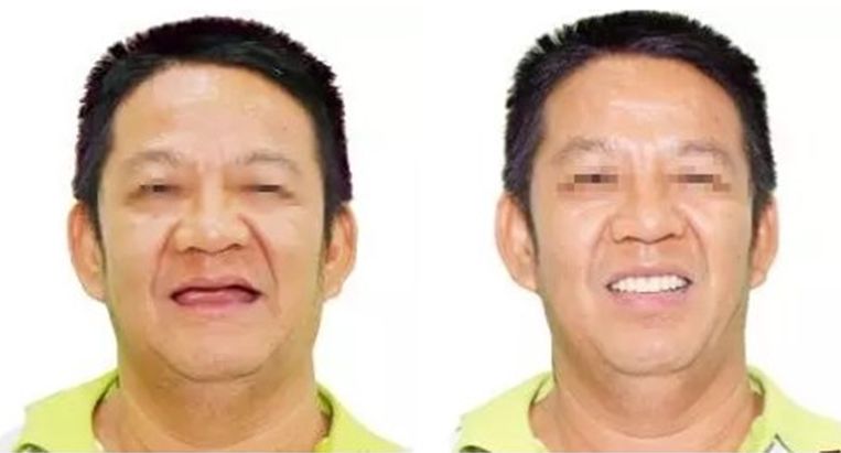 速看！11月起，这些新规实施，矫正牙齿、种植牙这些费用全免！