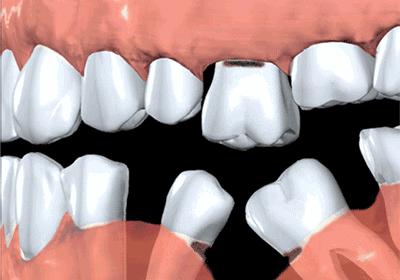 武汉种植牙齿需要多少钱,武汉种植牙齿一颗要多少钱