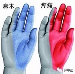 「警惕」手指麻痛，小心是腕管综合征！佛中医腕管镜微创治顽疾