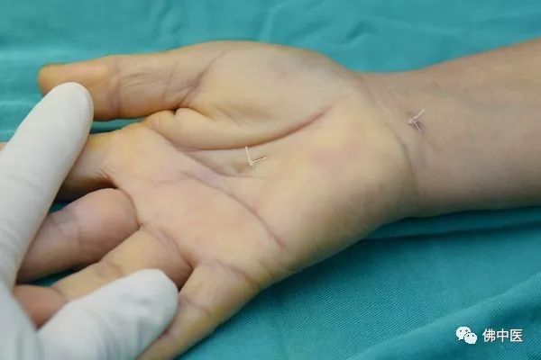 「警惕」手指麻痛，小心是腕管综合征！佛中医腕管镜微创治顽疾