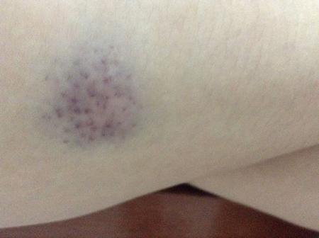 皮肤出现紫色瘀斑吃什么药,皮肤上有瘀斑是什么原因引起的