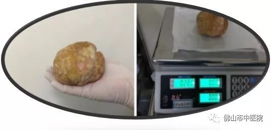 小心膀胱结石,膀胱结石的初期症状是什么