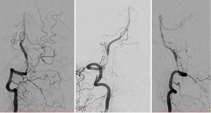 椎动脉起始段狭窄的介入治疗ppt,椎动脉v4段假性动脉瘤介入治疗