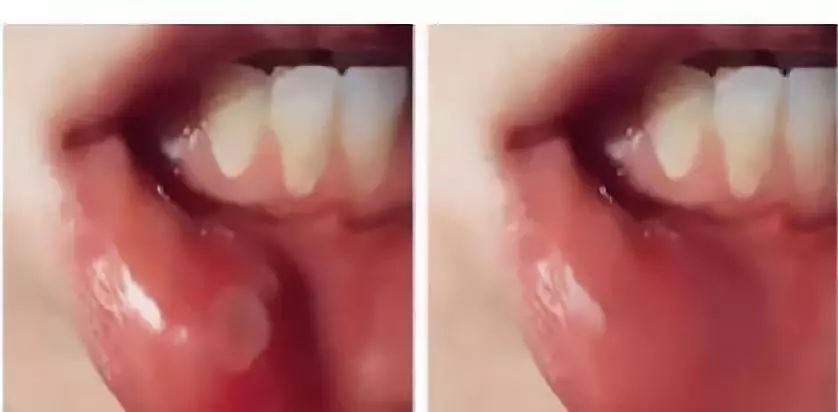 三十秒止痛口腔溃疡,5秒钟治口腔溃疡的药