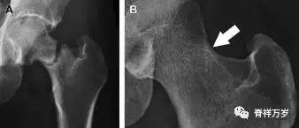 肩关节脱位易漏诊的骨折,放射科容易漏诊的骨折
