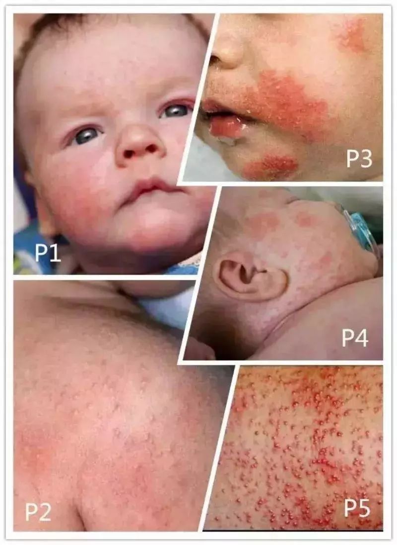 皮肤湿疹万能膏,泰国顽固性皮肤病排毒止痒膏