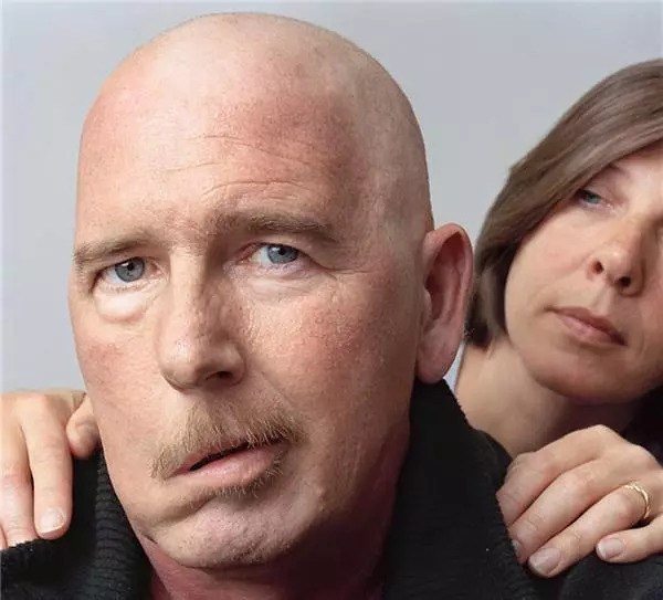 康复科治疗面瘫效果怎么样,面瘫康复训练评分