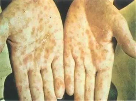 80岁老人查出梅毒是什么原因,男子体检查出梅毒原因让人震惊了