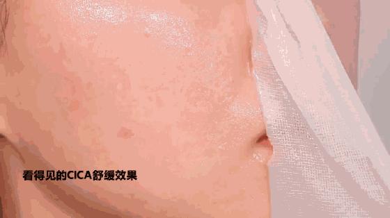 推荐的祛痘面膜青春期,祛痘紧急修复面膜