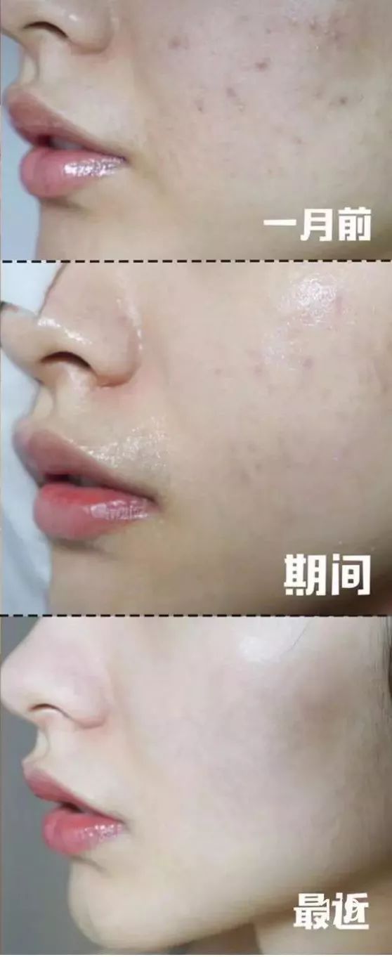 红肿，流脓的万年毒痘一喷全消失？岛国新晋痘肌终结者！彻底祛痘不反复！