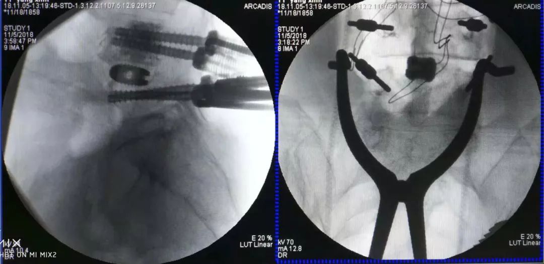 骨水泥治疗老年压缩性腰椎骨折,骨水泥治疗骨质疏松脊柱骨折