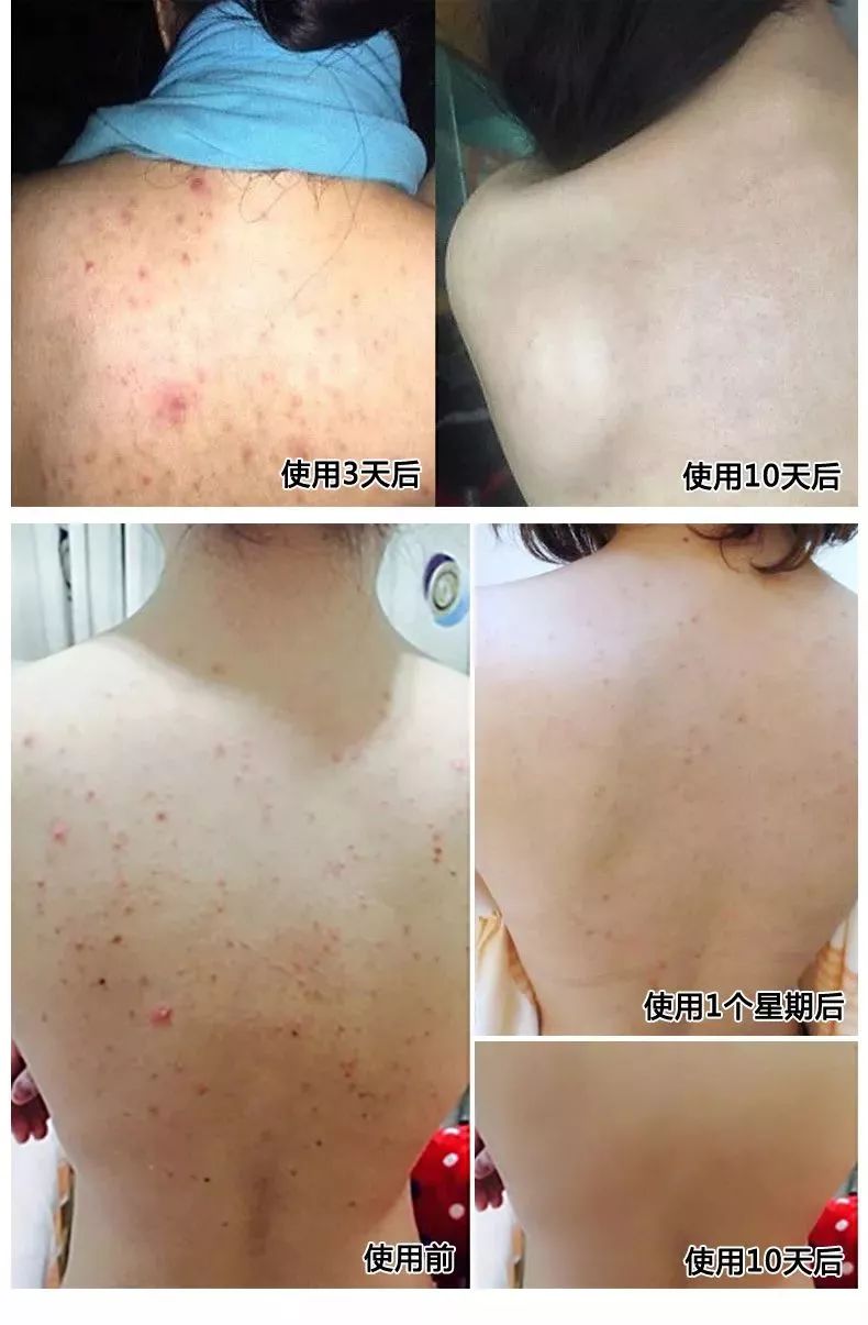 人脸上螨虫的数量,人脸上有多少螨虫