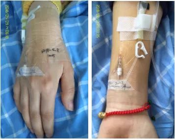 三发性静脉炎的预防措施有哪些,临床上如何预防化疗引起的静脉炎