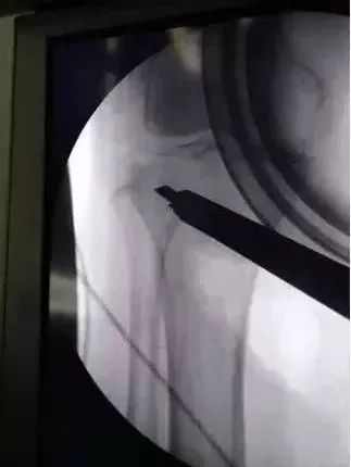 膝关节置换是微创还是开刀,膝关节置换必须要用助行器吗