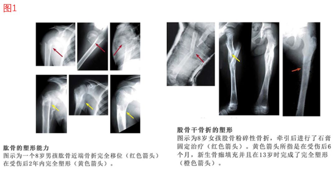 孩子胳膊骨折伸不直康复训练,小孩胳膊骨折需要做康复训练吗