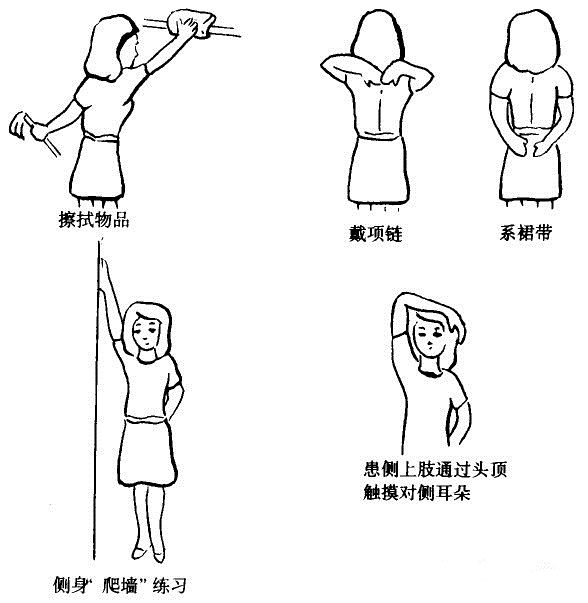 「肿瘤小课堂」乳腺癌术后胳膊肿怎么办？