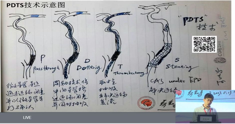 CINS快报｜“介入大家谈”复杂颈动脉关键处理技术