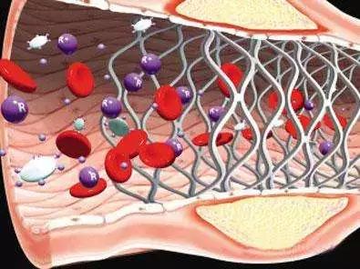 冠脉造影支架手术的全过程,冠脉造影支架术护理查房