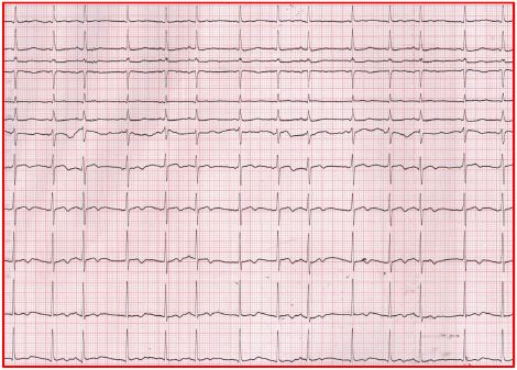 做完消融手术后胸闷憋气,射频消融术后胸闷气短是怎么回事