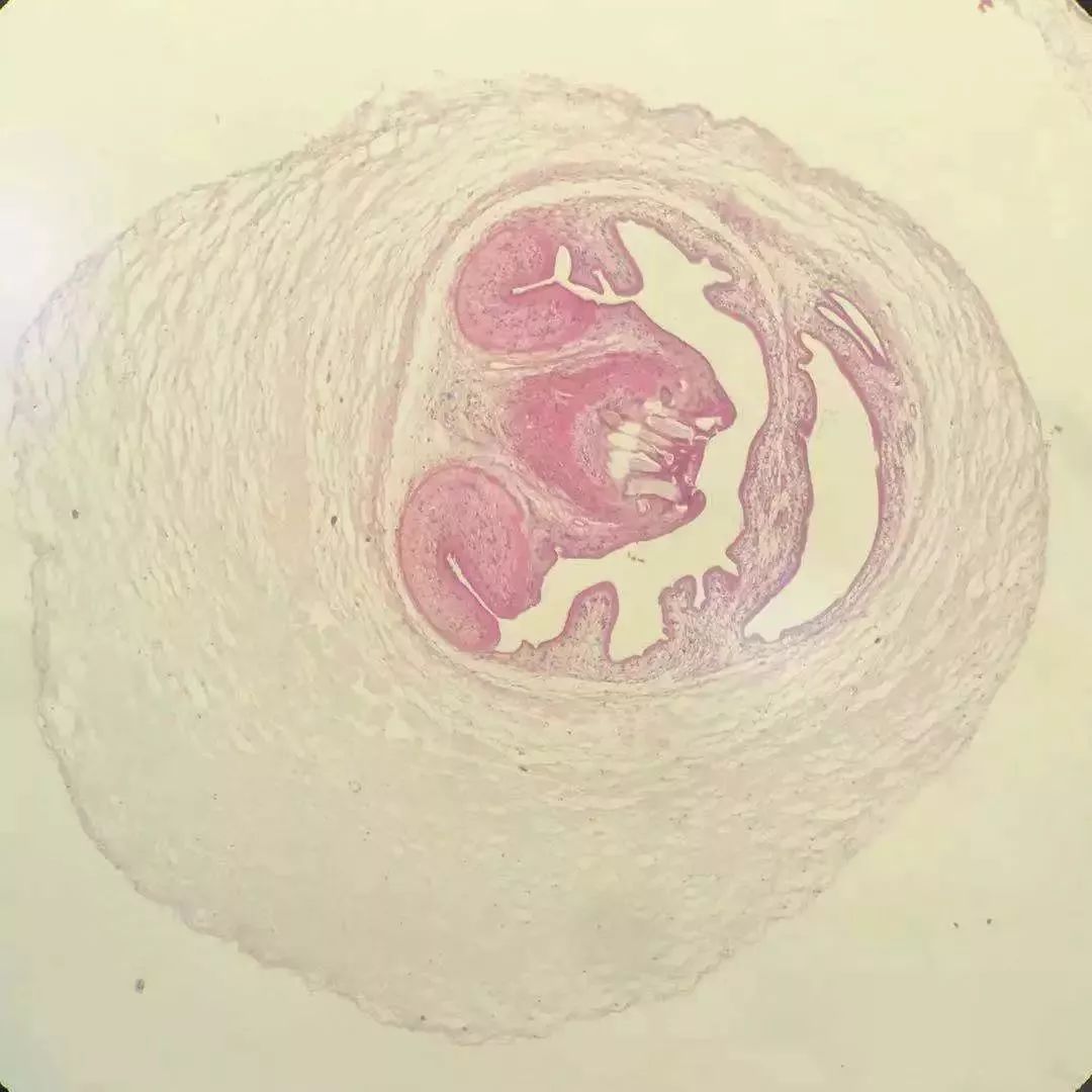 头皮发麻女生,头上长个包取出一条虫