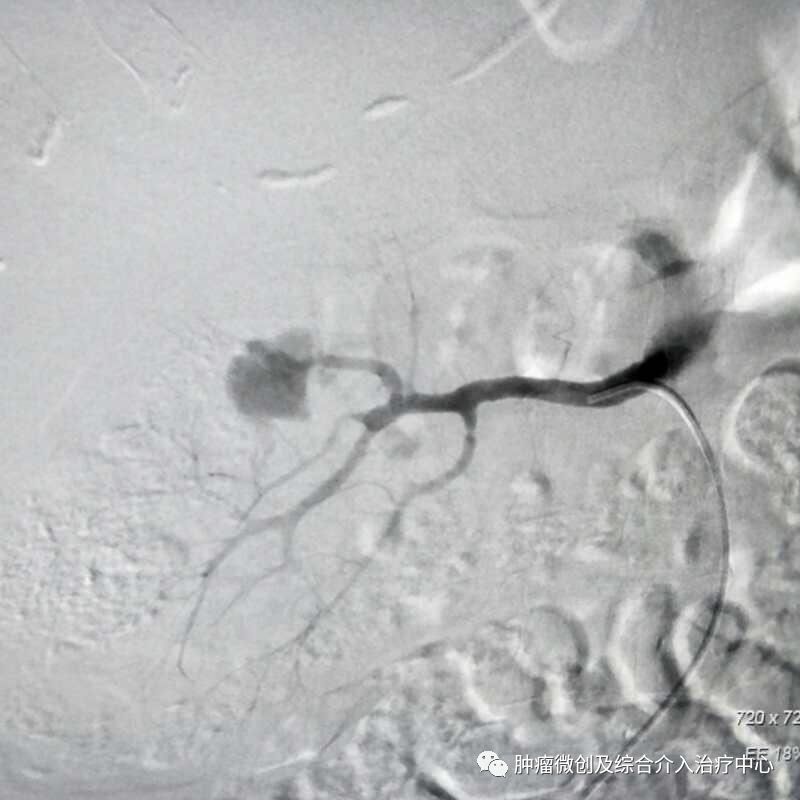 运城第一医院肿瘤介入科专家,运城市第一医院介入科专家