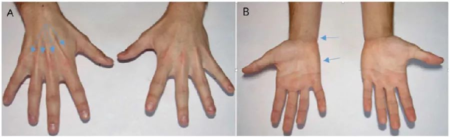 手部无力,年轻人右手无力警惕三种疾病