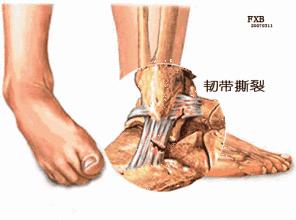 崴脚韧带撕裂需要多长时间恢复,崴脚了怎么护理饮食