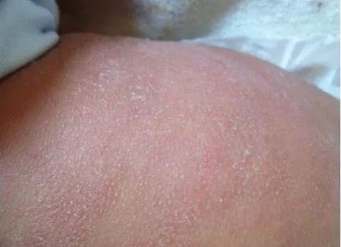 一岁半宝宝皮肤粗糙怎么回事,一岁半宝宝很皮