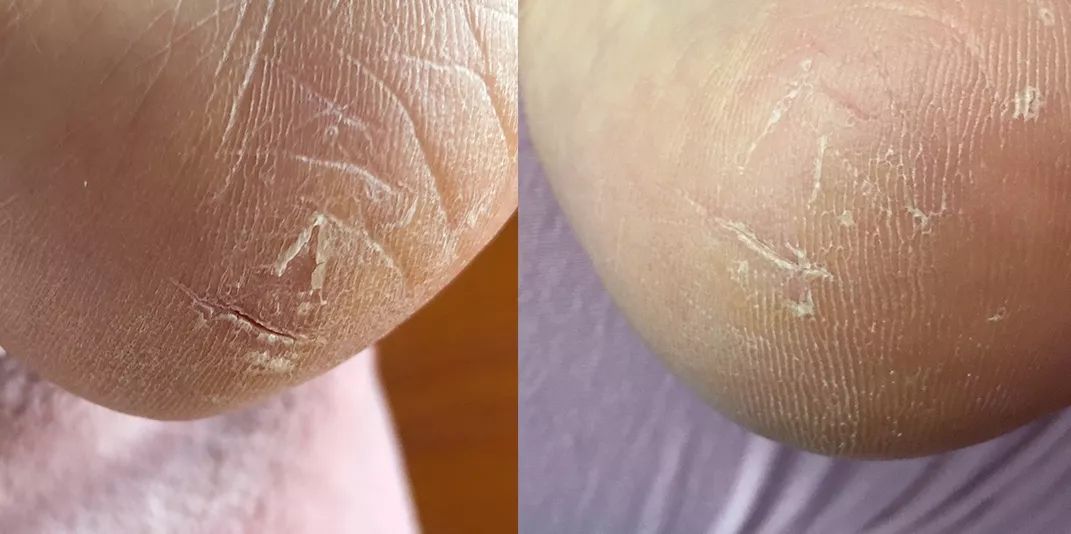 冬天干燥脚后跟干裂又起皮怎么办,冬天脚后跟干裂买什么涂