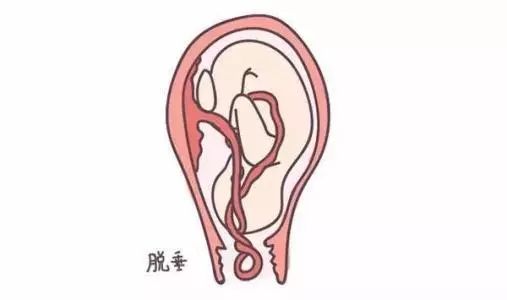 胎儿脐带先露会造成脐带脱垂吗,脐带先露发生脐带脱垂风险有多高