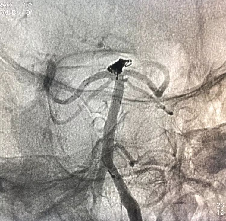 柳暗花明专栏|栓塞颅内动脉瘤时微导管无法穿过LVIS支架网眼怎么办