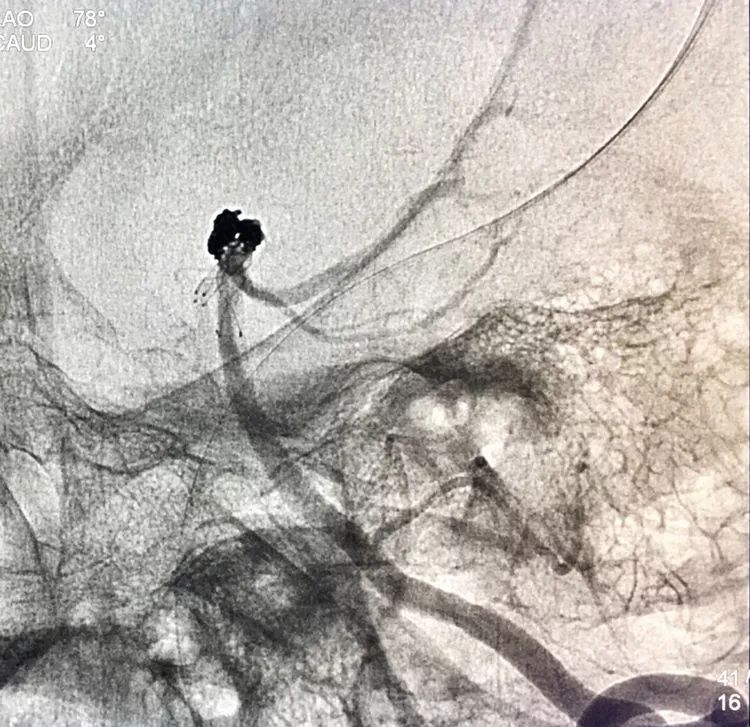 柳暗花明专栏｜栓塞颅内动脉瘤时微导管无法穿过LVIS支架网眼怎么办
