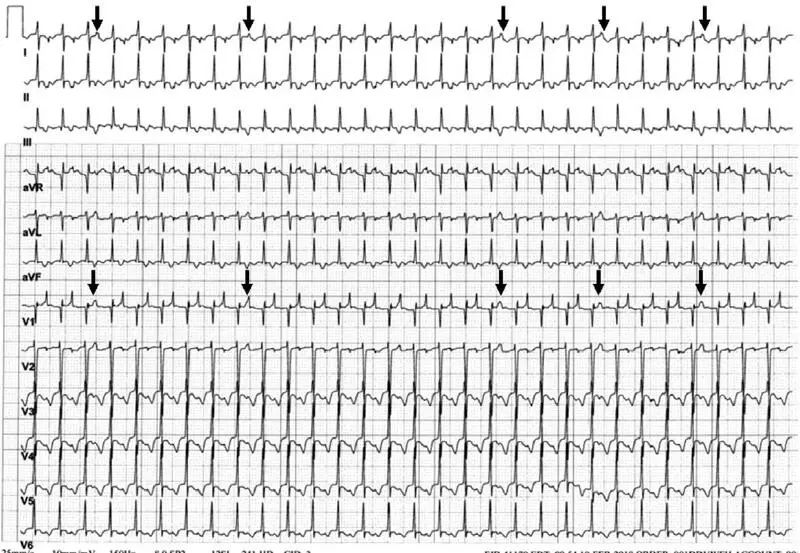 女孩无休止室上速?“真凶”样子有点“怪”!