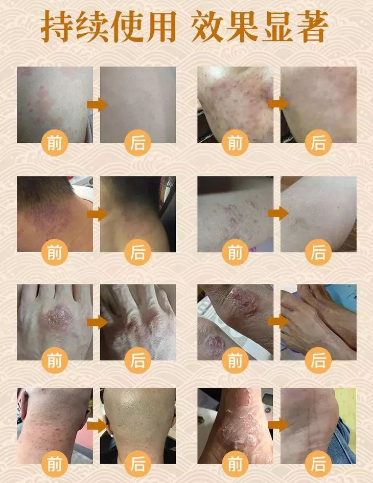 清凉止痒防暑醒神膏,止痒的草药膏