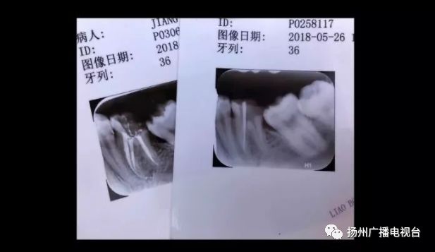 江都17岁女孩去医院看牙，一根针留在了牙齿里！专家表示……