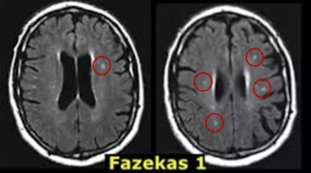 医生，我片子报告“腔梗”了！怎么办？