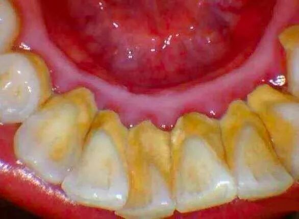 为什么中国人总是老掉牙,中国人啥时候开始掉牙