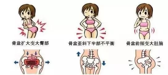 骨盆倾斜能根治吗,骨盆歪斜影响生育吗