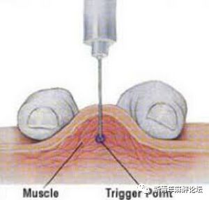 落枕了怎么办最快最有效方法,落枕了怎么办按什么穴位