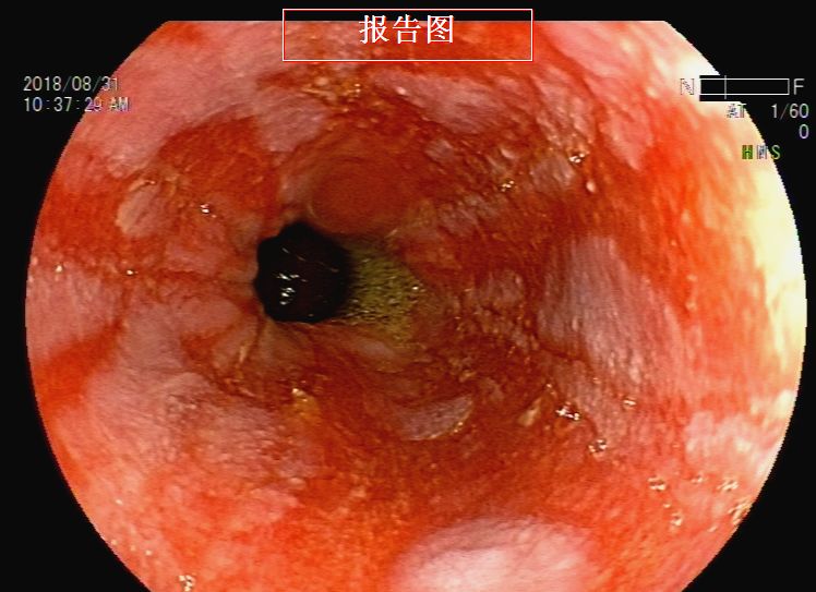 消化道支架置入术,消化道梗阻支架怎么放