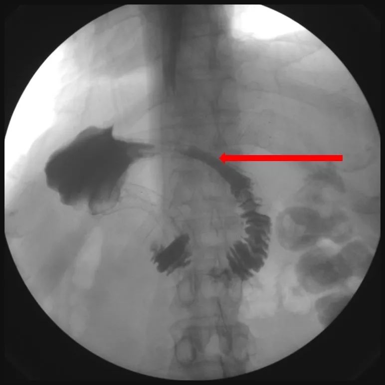 消化道支架置入术,消化道梗阻支架怎么放