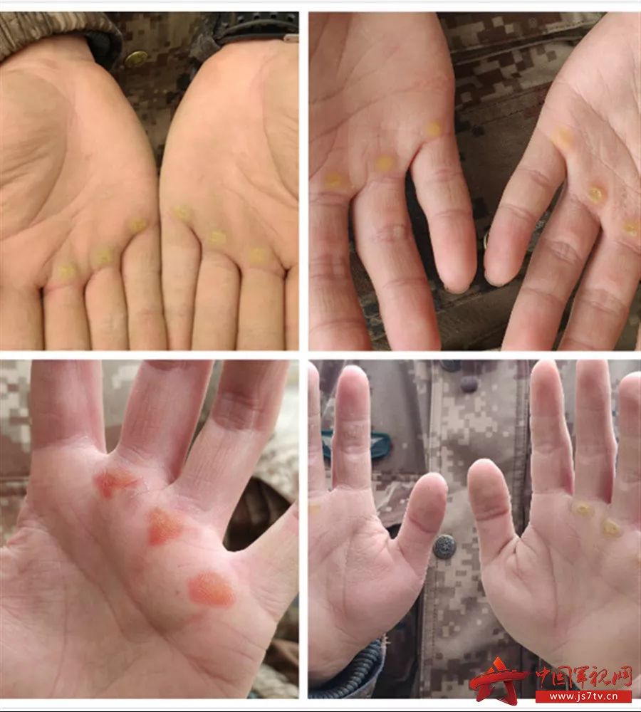 伸出右手看看你有几道手纹,手指无原因起老茧是什么原因